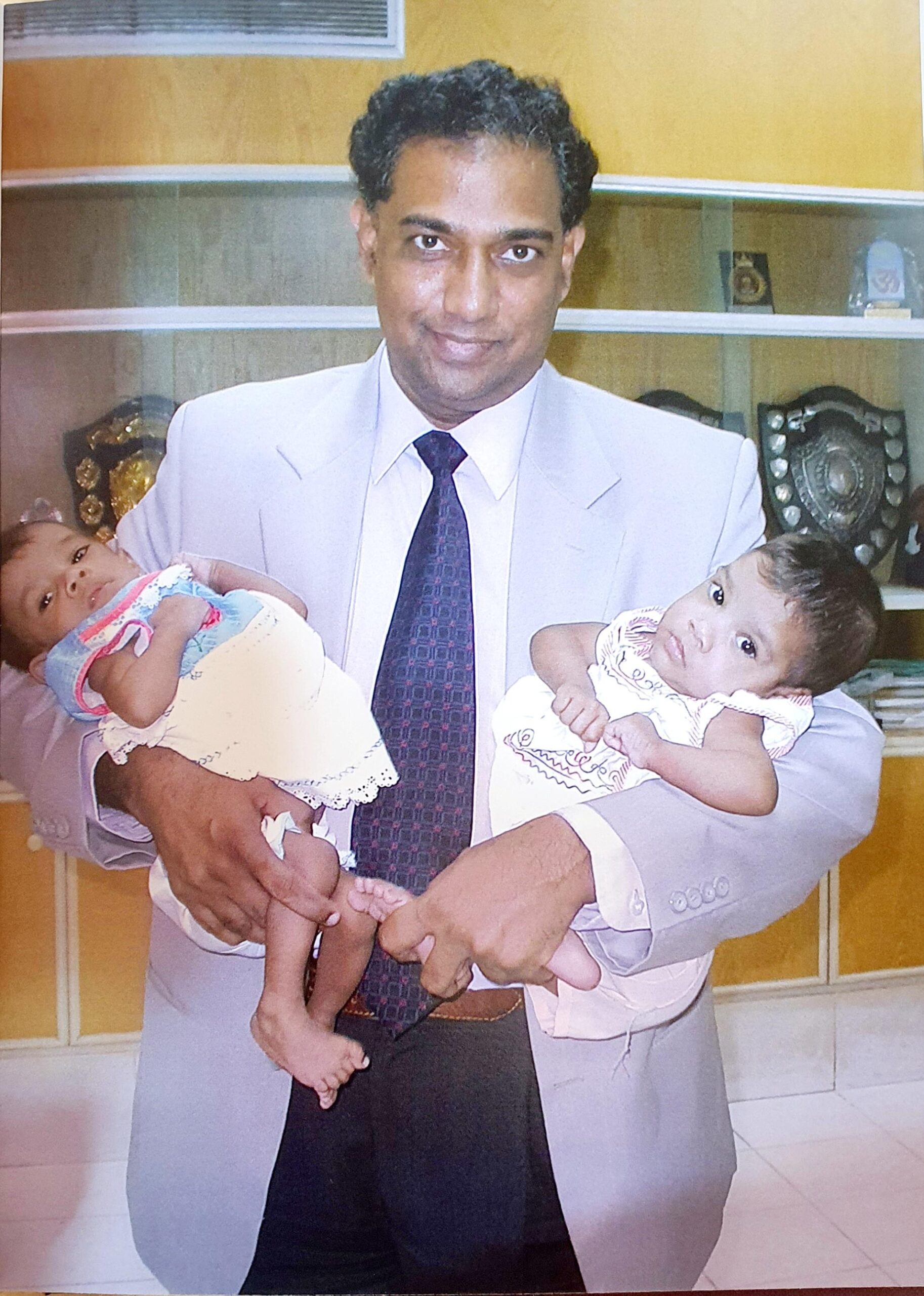 Twins separated by surgery